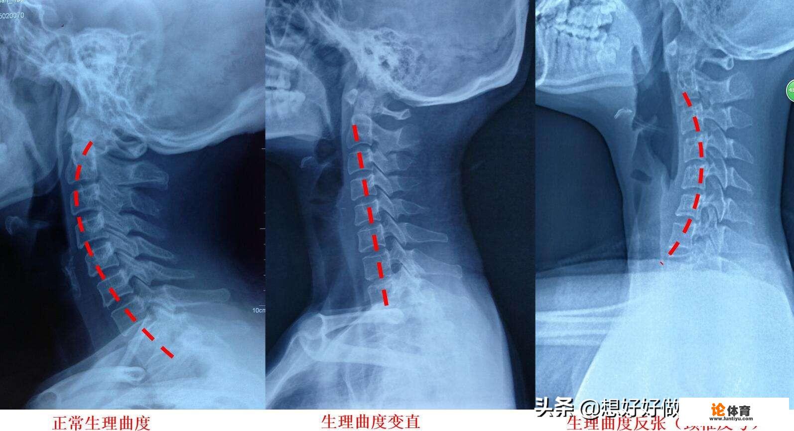 肩背痛松解筋膜有哪些方法