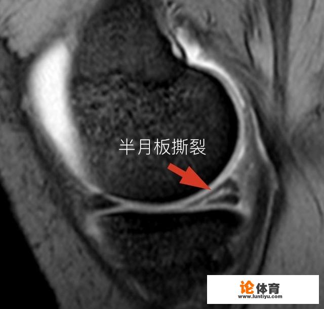 半月板能自己康复吗？_仙桃桌球比赛视频直播回放