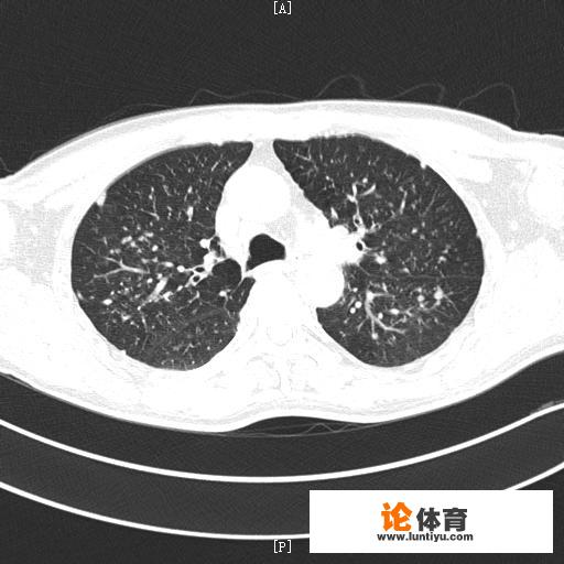 得了肺结节，该怎么办？平常需要注意什么