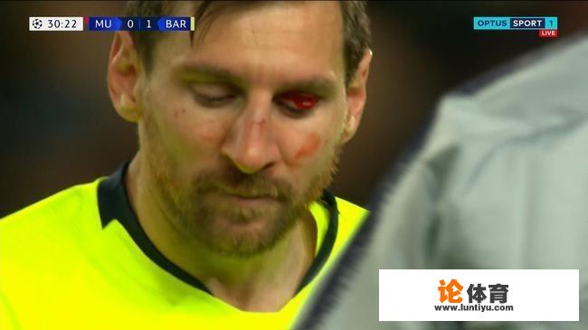 震惊,斯莫林让梅西血流不止,是无意还是故意 震惊,斯莫林让梅西血流不止,是无意还是故意