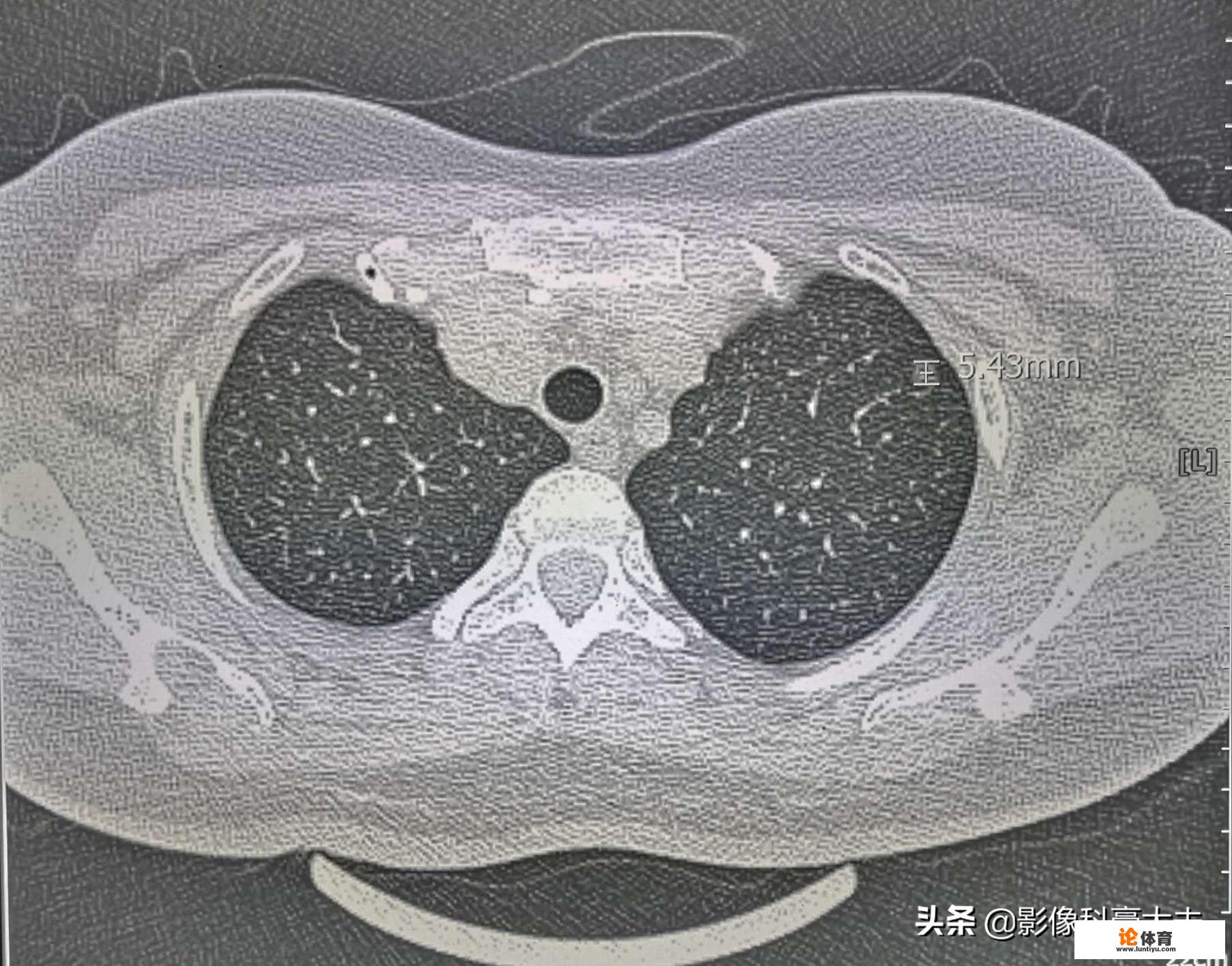 肺结节是怎么回事