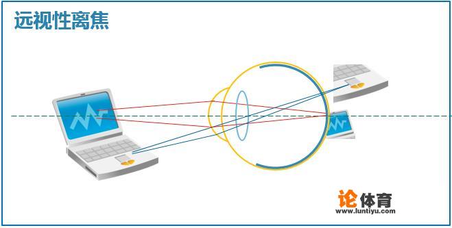 近视眼的孩子打羽毛球是否有益