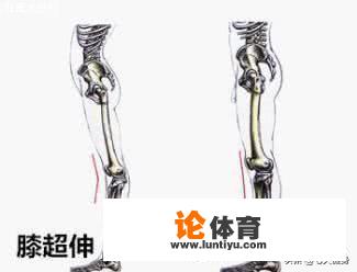 膝关节超伸困扰好多年，连紧身裤都不敢穿，该怎么办？